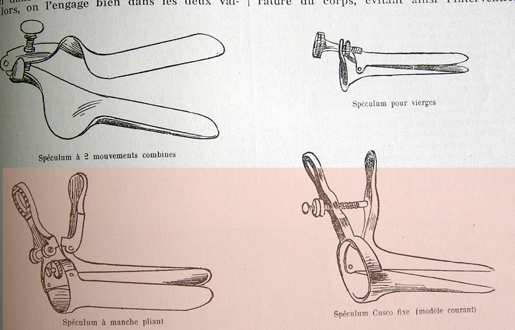 storia dello speculum vaginale,history of Vaginal Specula, histoire du
